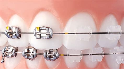 sonrisa con brackets ceramicos y metalico|Brackets Cerámicos Y Metálicos: 7 Puntos De .